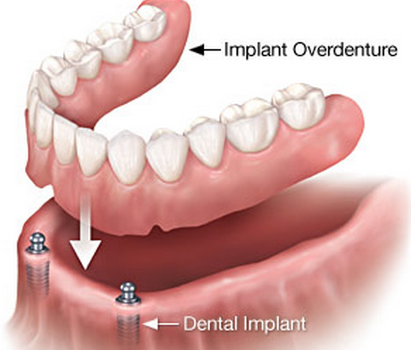 Dental Implants Fix Loose Dentures